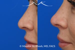 Photo of a patient before and after a procedure. Liquid rhinoplasty - Filler injection into the nasal tip allowed improved rotation of the nasal tip without surgery.